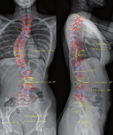 2D  Full Spine X-ray image