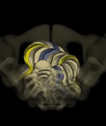 3D 骨骼影像了解脊椎旋轉情況