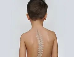 Scoliosis Treatment