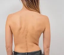 Scoliosis Treatment