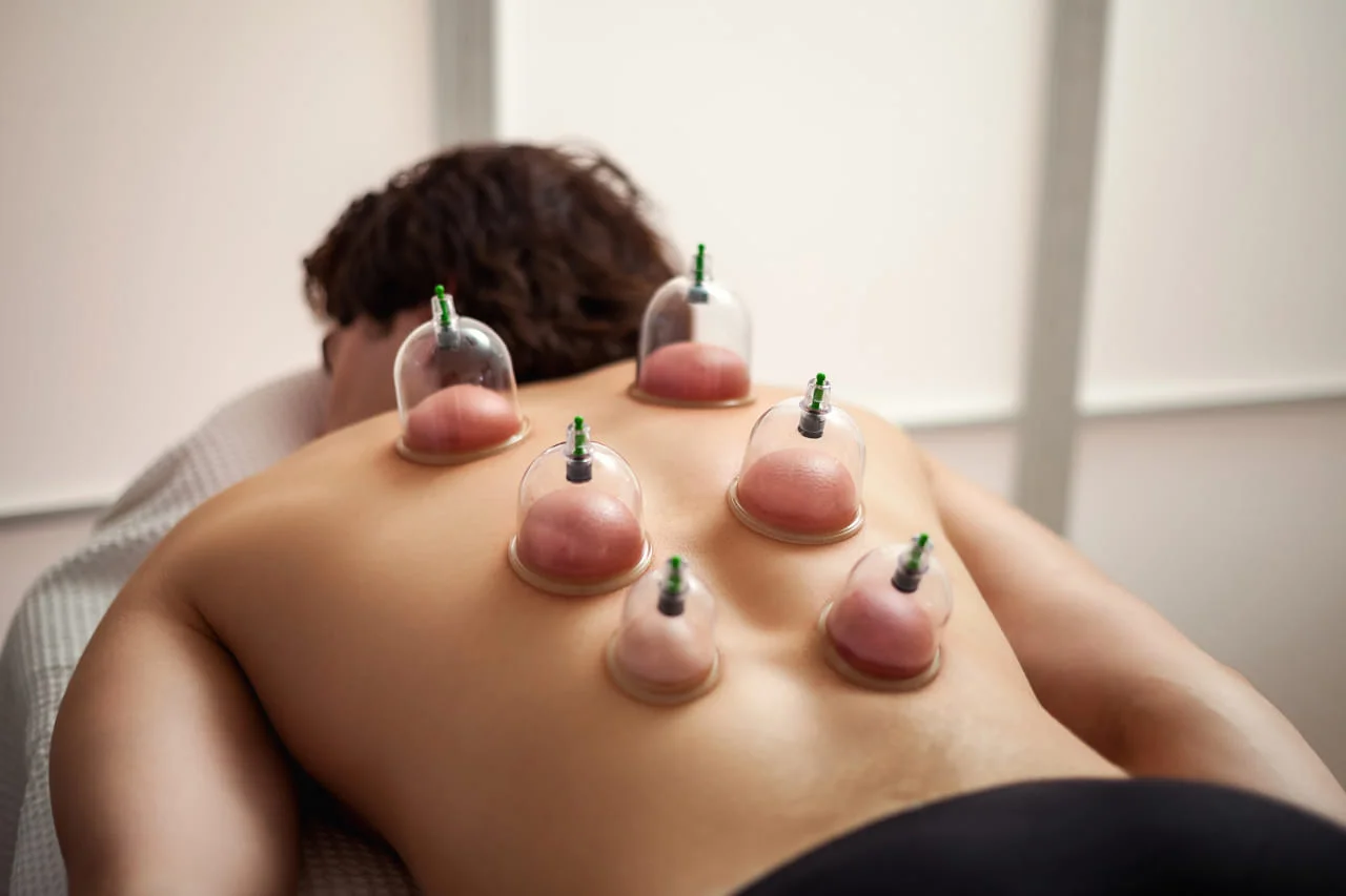 Cupping Therapy 